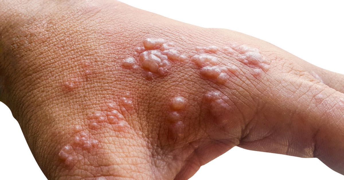 Skin infected Herpes zoster virus on the arms